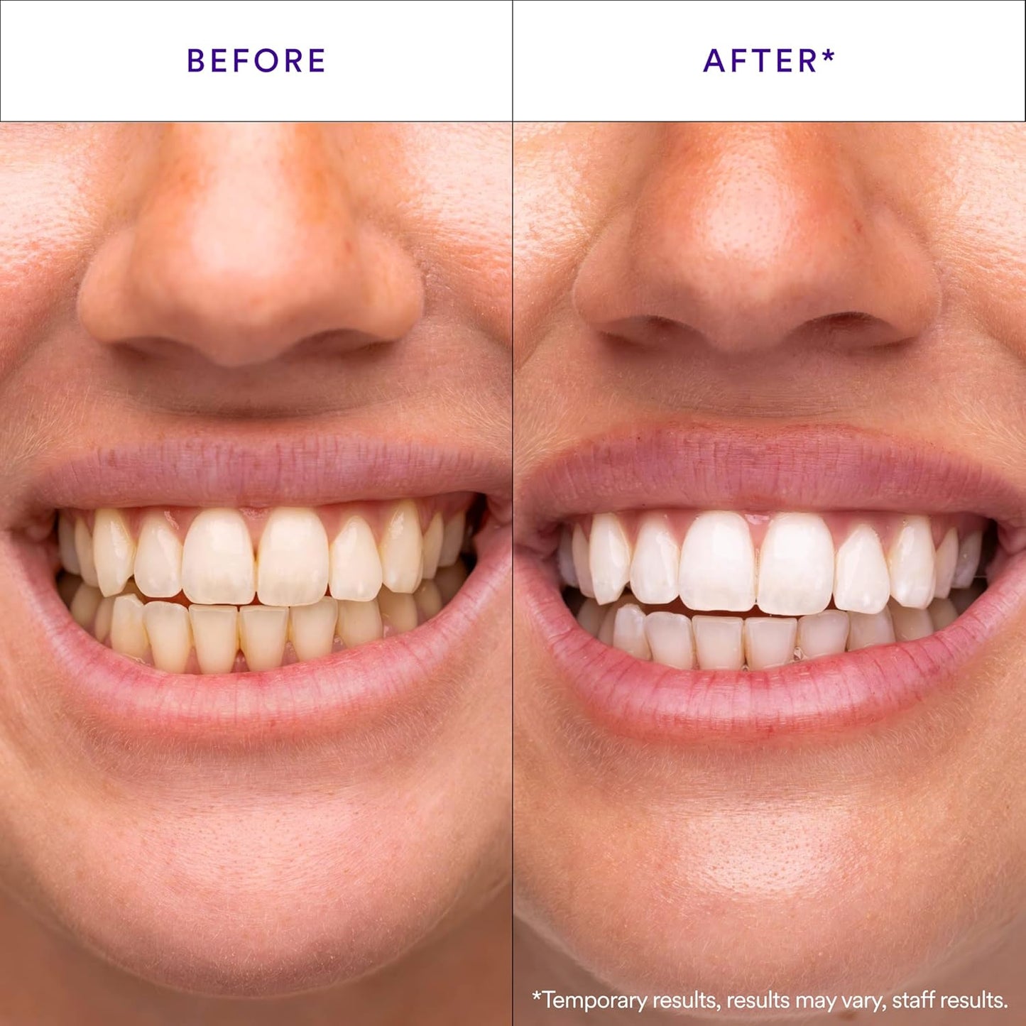 Hismile V34 Whitening Strips