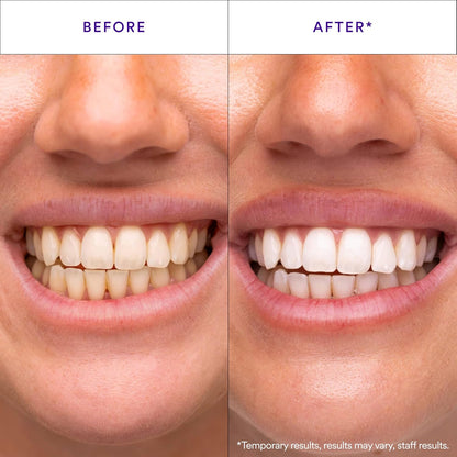 Hismile V34 Whitening Strips